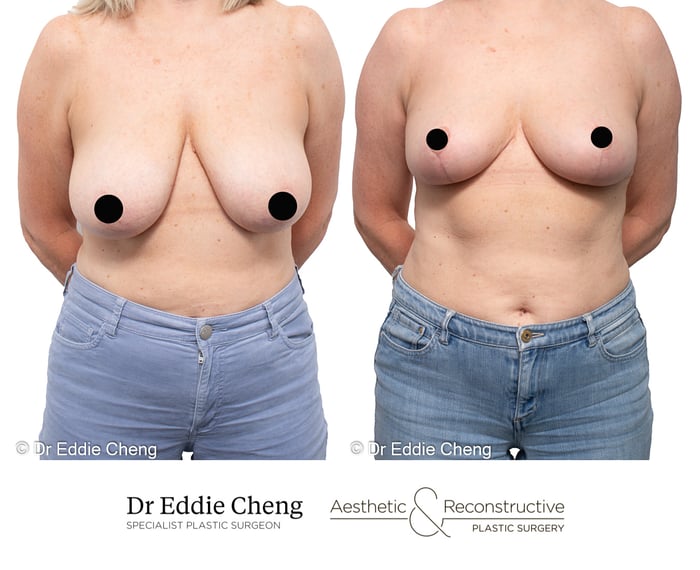 Understanding Breast Reduction Surgery with Dr Eddie Cheng in Brisbane