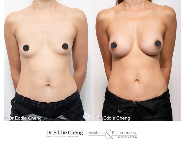 Breast Augmentation in Brisbane with Specialist Plastic Surgeon Dr Eddie Cheng