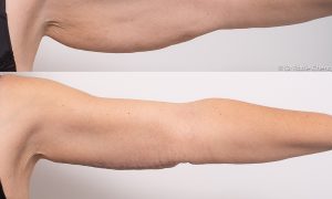 What Is Arm Lift or Brachioplasty Surgery