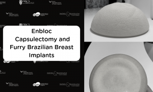 Enbloc Capsulectomy and Furry Brazilians or Polyurethane Breast Implants