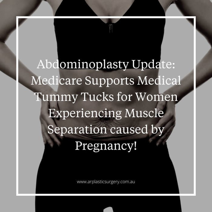 Abdominoplasty Update: Medicare Supports Medical Tummy Tucks for Women Experiencing Muscle Separation Caused by Pregnancy!