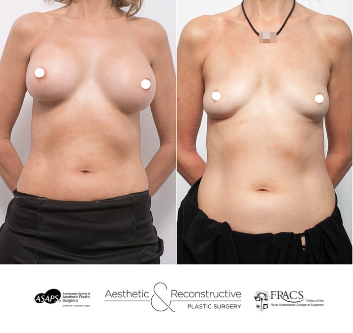 What You Should Know About Explant Surgery or Breast Implant Removal Surgery?