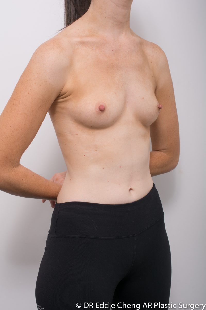 BILATERAL-Breast-Augmentation-PRE-Dr_Eddie_Cheng_Specialist_Plastic_Surgeon_Brisbane-002-800x1200