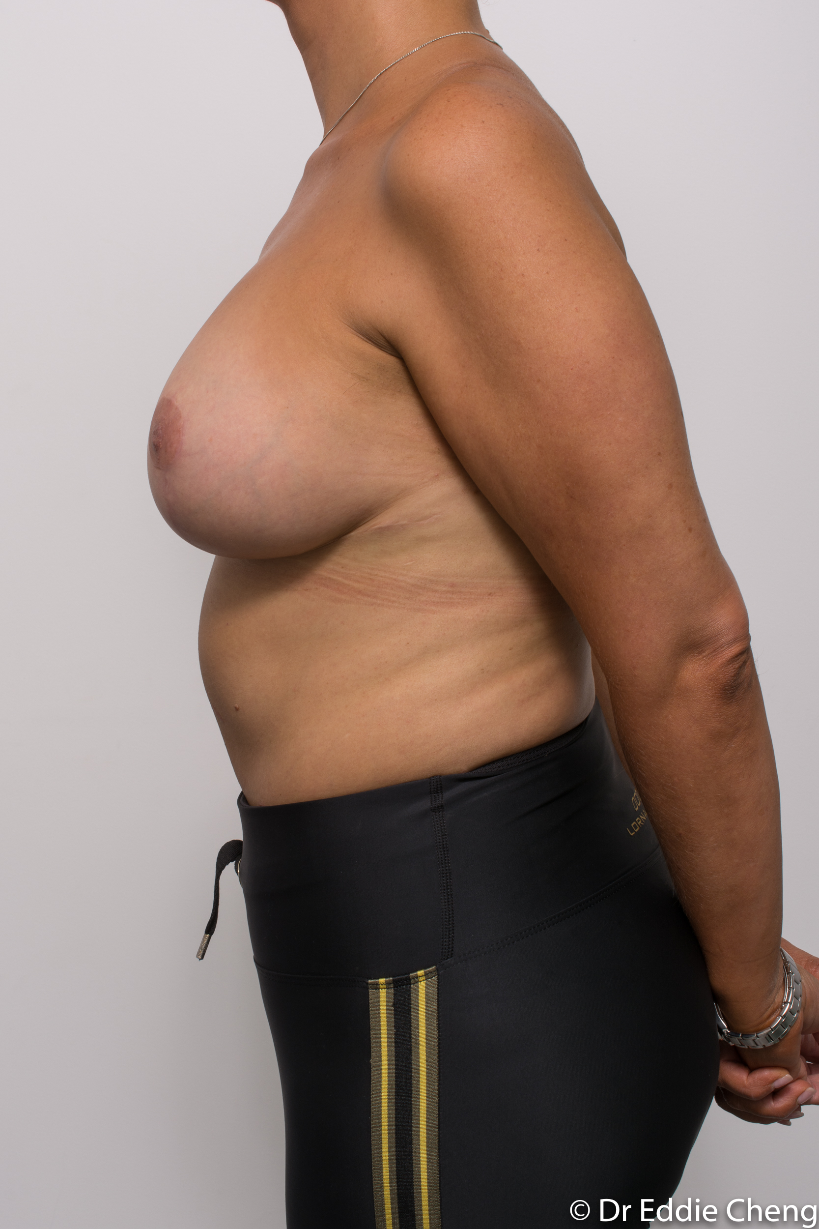 breast reduction brisbane by Dr Eddie cheng-2-5