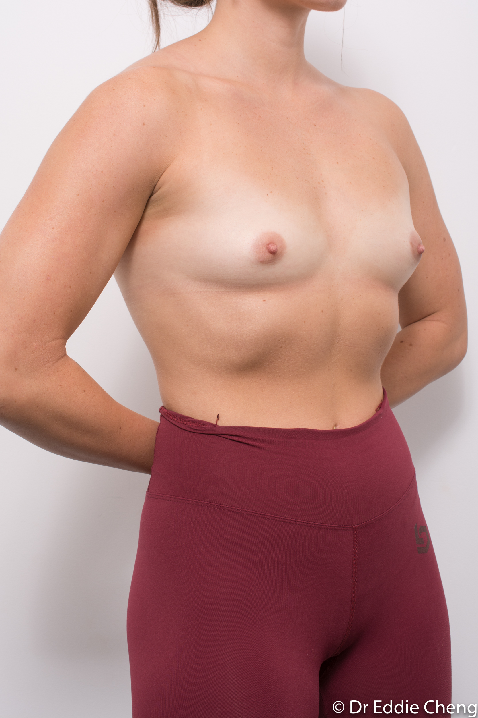 pre op breast augmentation brisbane dr eddie cheng-2